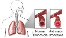 Bronchial comparisons