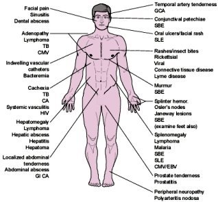 Epstein Barr Syndrome symptoms.