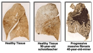 Lung comparison