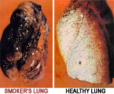 Smoker's lung vs. Healthy Lung