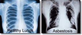 Healthy lungs vs. asbestosis lungs